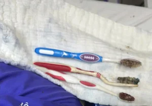 Medical Miracle: Surgeons Successfully Remove Three Toothbrushes from Patient’s Stomach in Complex Procedure - image 0