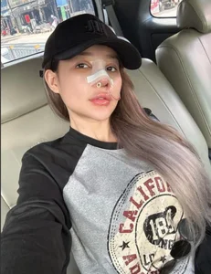 Ngân 98's Beauty Evolution: A Closer Look at Her 12 Rhinoplasty Procedures - image 0